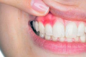 İltihaplı Dişe Ne İyi Gelir? 3 İltihaplı Diş