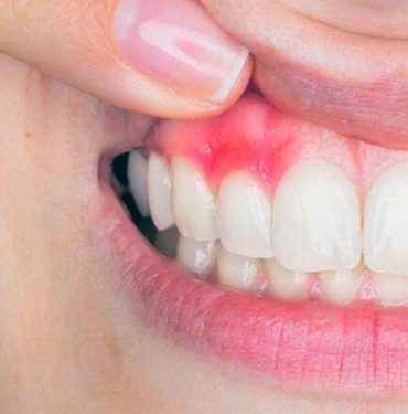 İltihaplı Dişe Ne İyi Gelir? 9 İltihaplı Diş