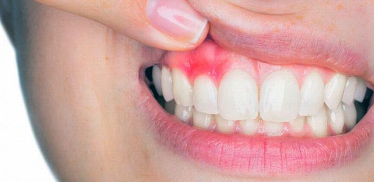 İltihaplı Dişe Ne İyi Gelir? 6 İltihaplı Diş