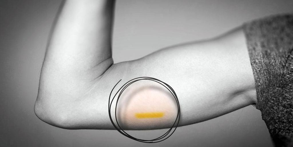 Emzirme Döneminde Korunma Yöntemleri 3 NEXPLANON (Cilt altı implant çubuk )