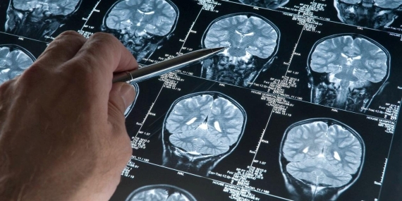 Alzheimer Hastalığı ve Müzik Terapisi