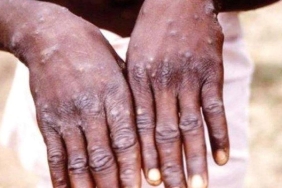 Afrika'da M Çiçeği Nedeniyle Hayatını Kaybedenlerin Sayısı 1100'e Ulaştı 1 afrikada-m-cicegi-nedeniyle-hayatini-kaybedenlerin-sayisi-1100e-ulasti-auZMXUmZ.jpg