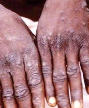 Afrika'da M Çiçeği Nedeniyle Hayatını Kaybedenlerin Sayısı 1100'e Ulaştı 10 afrikada-m-cicegi-nedeniyle-hayatini-kaybedenlerin-sayisi-1100e-ulasti-auZMXUmZ.jpg