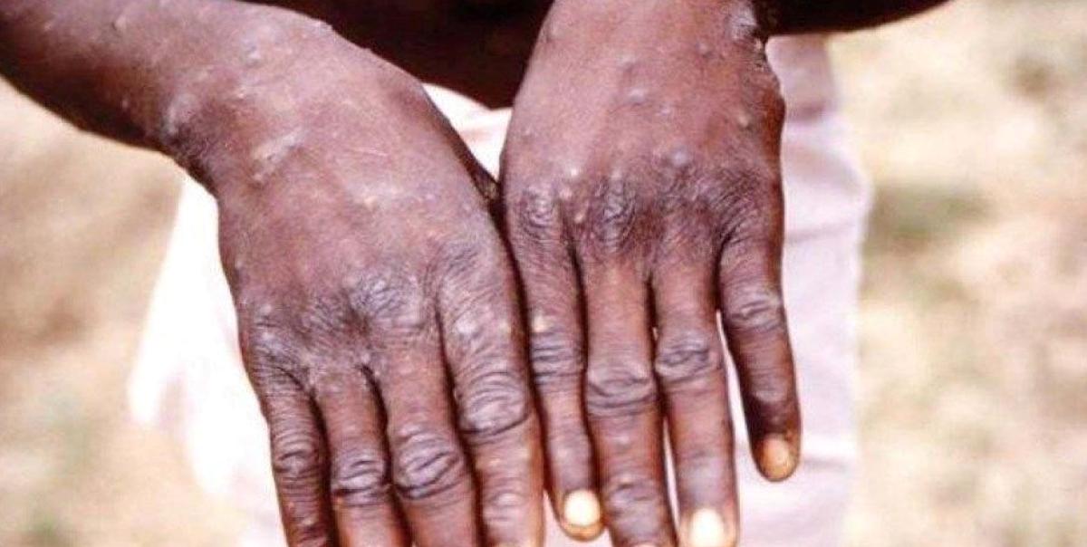 Afrika'da M Çiçeği Nedeniyle Hayatını Kaybedenlerin Sayısı 1100'e Ulaştı 2 afrikada-m-cicegi-nedeniyle-hayatini-kaybedenlerin-sayisi-1100e-ulasti-auZMXUmZ.jpg