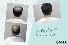 Onna Hair Protez Saç ile Kendinizi Keşfedin! 1 protez-sac-onna-hair