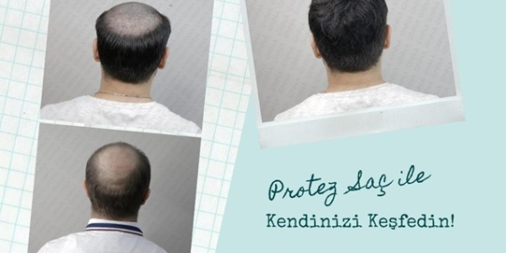 Onna Hair Protez Saç ile Kendinizi Keşfedin!