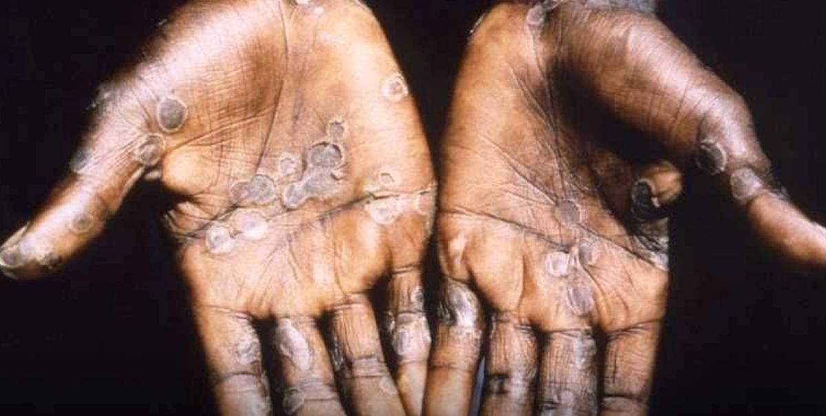 Zimbabve ve Zambiya'da İlk M Çiçeği Vaka Gözlemleri! 2 zimbabve-ve-zambiyada-ilk-m-cicegi-vaka-gozlemleri-eCDQ8cuD.jpg
