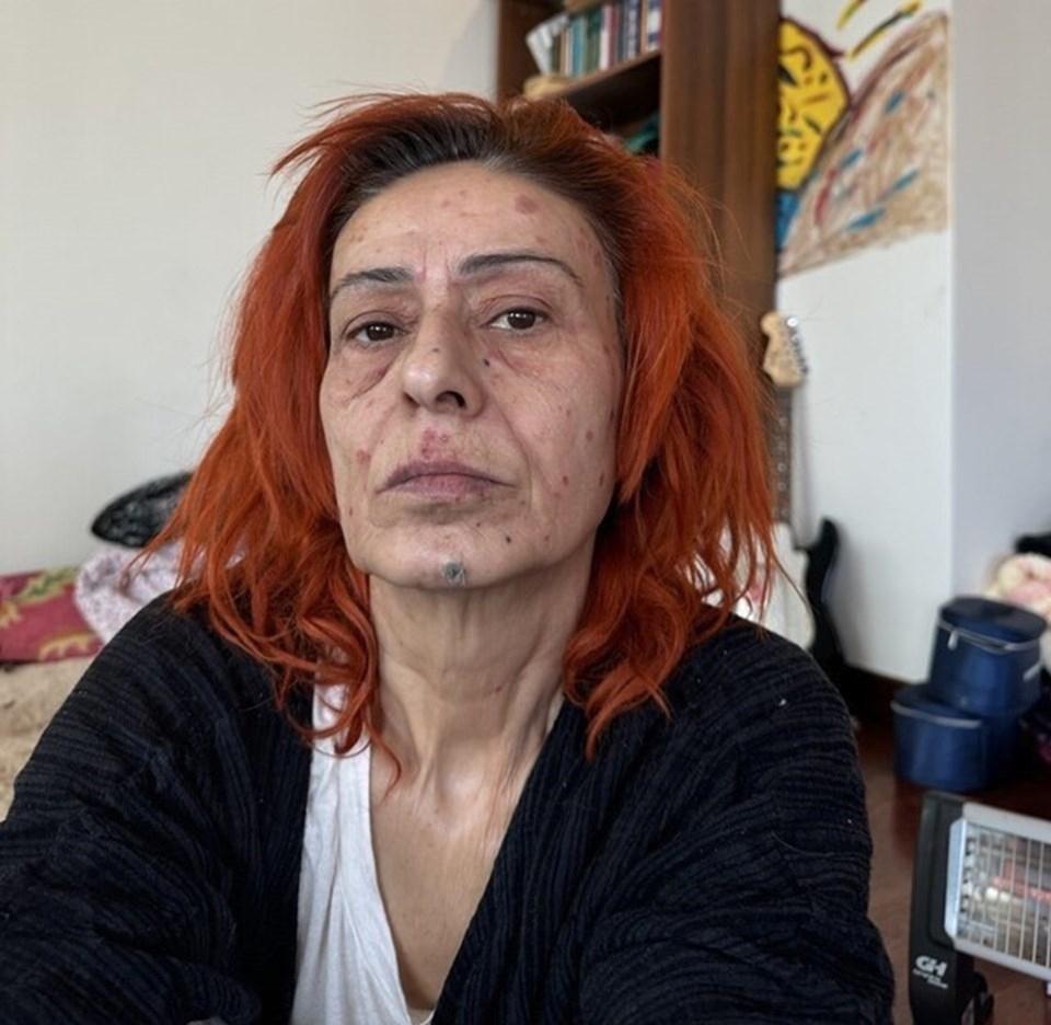 Yıldız Tilbe'nin Yanık Yüzüyle Maskeli Pozu Dikkat Çekti 1 Yıldız Tilbe'nin Talihsiz Olayı