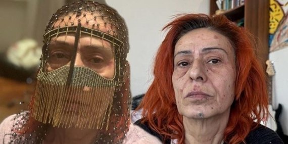 Yıldız Tilbe’nin Yanık Yüzüyle Maskeli Pozu Dikkat Çekti