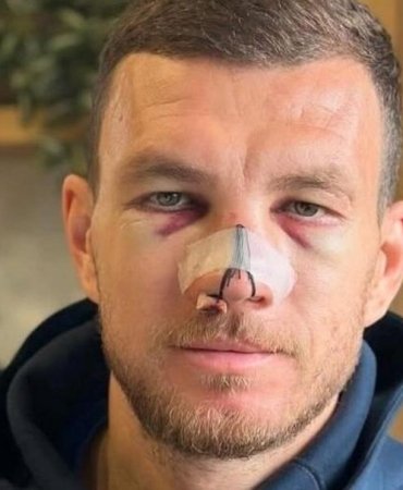 Edin Dzeko Burnunu Kırdı, Ameliyat Olmayacak: Sahalara Karbon Maskeyle Dönüyor 10 edin-dzeko-burnunu-kirdi-ameliyat-olmayacak-sahalara-karbon-maskeyle-donuyor-OlbqfetM.jpg