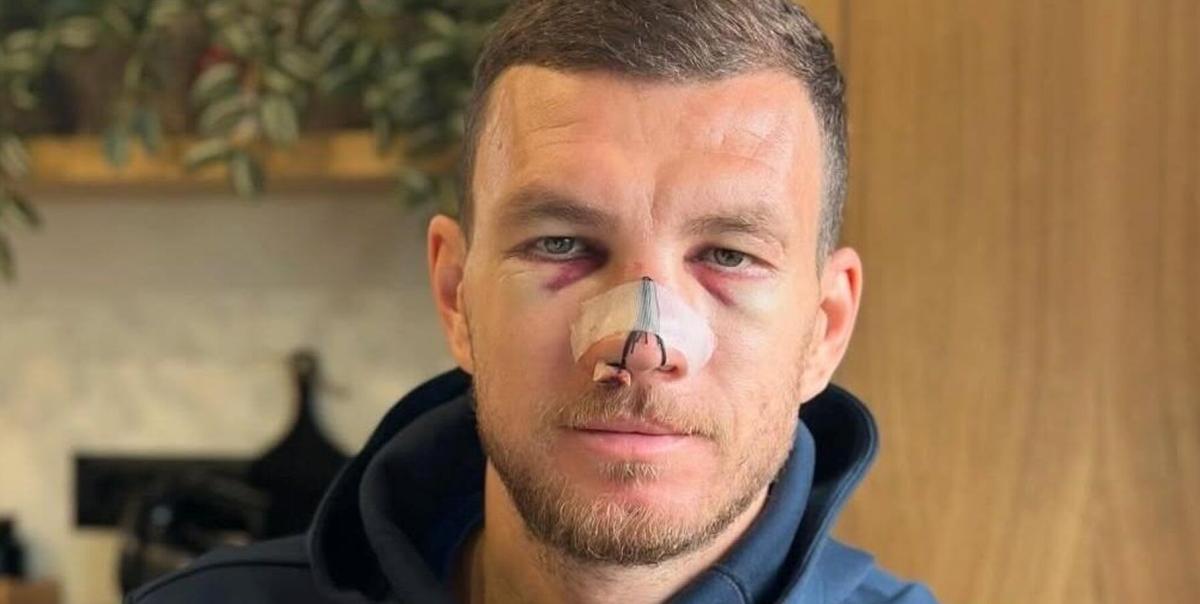 Edin Dzeko Burnunu Kırdı, Ameliyat Olmayacak: Sahalara Karbon Maskeyle Dönüyor 2 edin-dzeko-burnunu-kirdi-ameliyat-olmayacak-sahalara-karbon-maskeyle-donuyor-OlbqfetM.jpg