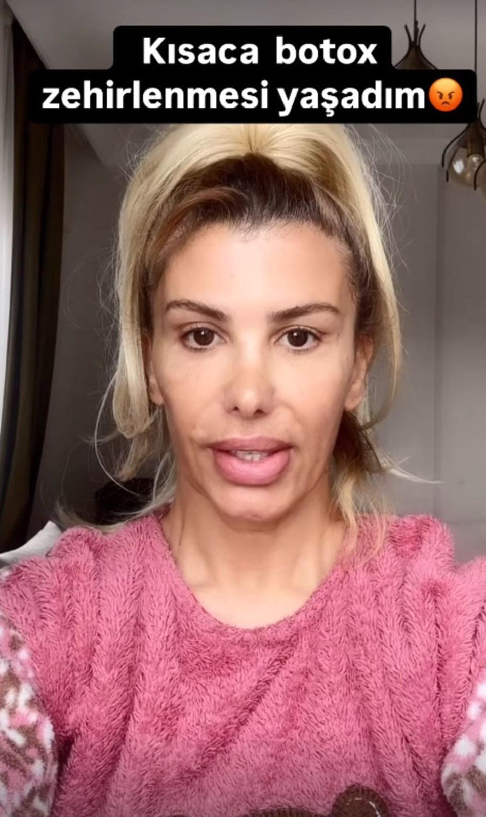 Şarkıcı Hatice'nin Botoks Zehirlenmesi: Son Halini Sosyal Medyada Paylaştı 1 Hatice'den Sağlık Açıklaması: Diş Sıkma Problemi ve Botoks