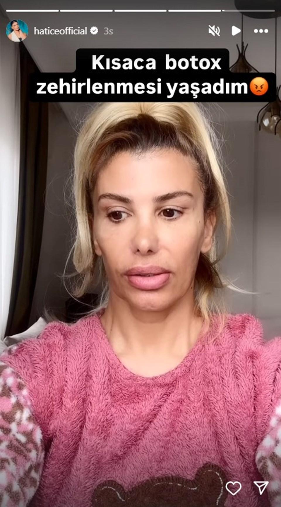 Şarkıcı Hatice'nin Botoks Zehirlenmesi: Son Halini Sosyal Medyada Paylaştı 2 Şarkıcı Hatice'nin Botoks Zehirlenmesi: Son Halini Sosyal Medyada Paylaştı