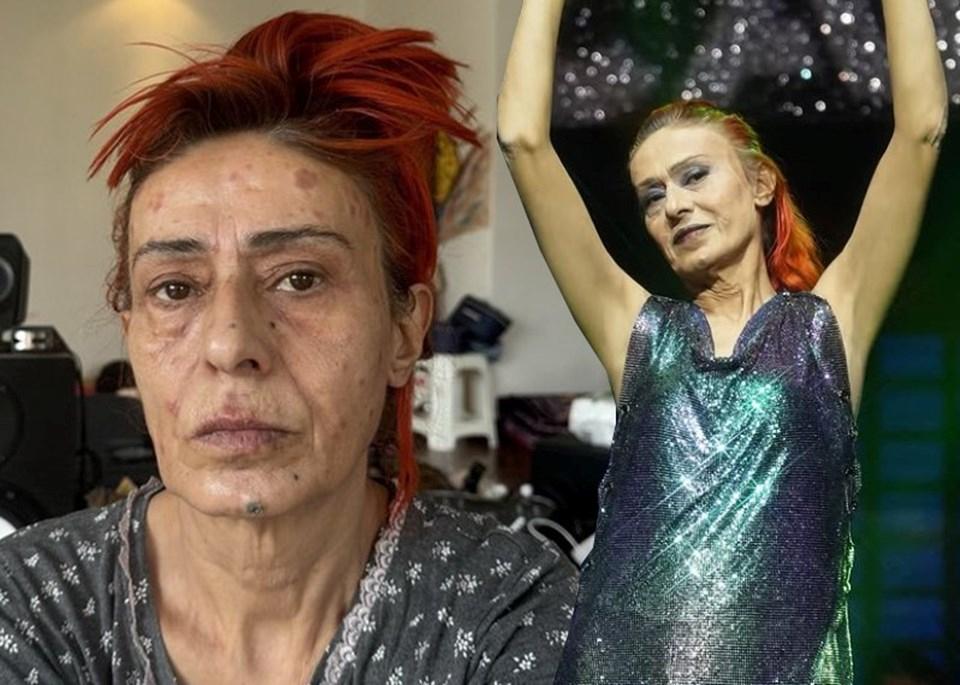 Yıldız Tilbe'nin Yüzündeki Yanıklar: Son Durumu Hakkında Açıklama 1 Bir Daha Saçına Boya Sürmeyecek