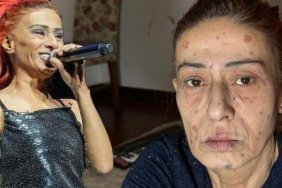 Yıldız Tilbe'nin Yüzündeki Yanıklar: Son Durumu Hakkında Açıklama 5 yildiz-tilbenin-yuzundeki-yaniklar-son-durumu-hakkinda-aciklama-eOXQXRJG.jpg