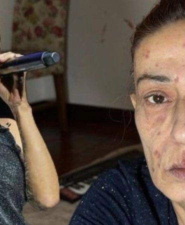 Yıldız Tilbe'nin Yüzündeki Yanıklar: Son Durumu Hakkında Açıklama 9 yildiz-tilbenin-yuzundeki-yaniklar-son-durumu-hakkinda-aciklama-eOXQXRJG.jpg