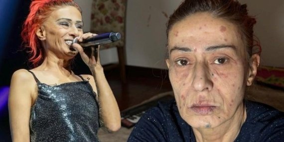 Yıldız Tilbe’nin Yüzündeki Yanıklar: Son Durumu Hakkında Açıklama