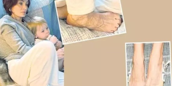 Zayıflama İğnelerinin Gizli Yan Etkisi: Ayaklarda Erken Yaşlanma!