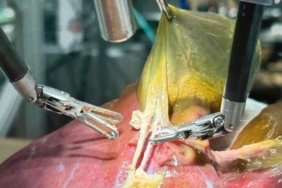 Doktorlara kötü haber: Bir robot, insan gibi ameliyat yapmayı başardı! 2 doktorlara-kotu-haber-bir-robot-insan-gibi-ameliyat-yapmayi-basardi-JaxtAfqW.jpg