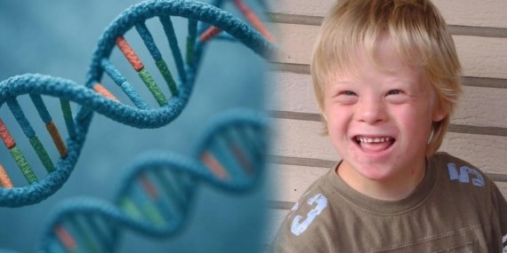 Down sendromunda devrim! Bilim insanları fazla kromozomu hücreden tamamen çıkardı