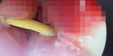 Ağızdan Yutup Yemek Borusunda Şiddetli Ağrı ve Saplanan Kemik Parçası: Endoskopik Müdahaleyle Kurtulan Olay 3 agizdan-yutup-yemek-borusunda-siddetli-agri-ve-saplanan-kemik-parcasi-endoskopik-mudahaleyle-kurtulan-olay-kOTQHElT.jpg