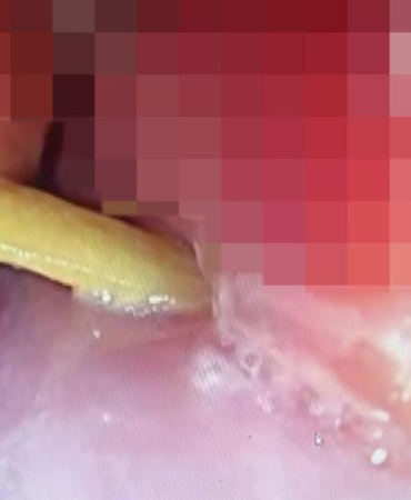 Ağızdan Yutup Yemek Borusunda Şiddetli Ağrı ve Saplanan Kemik Parçası: Endoskopik Müdahaleyle Kurtulan Olay 4 agizdan-yutup-yemek-borusunda-siddetli-agri-ve-saplanan-kemik-parcasi-endoskopik-mudahaleyle-kurtulan-olay-kOTQHElT.jpg