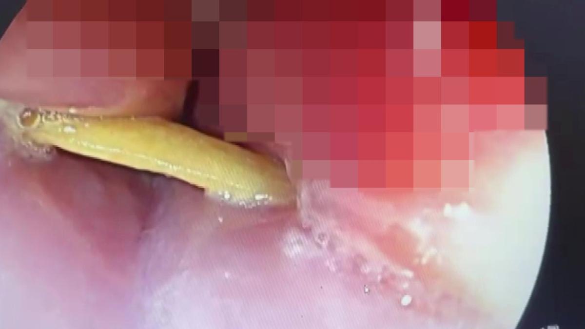 Ağızdan Yutup Yemek Borusunda Şiddetli Ağrı ve Saplanan Kemik Parçası: Endoskopik Müdahaleyle Kurtulan Olay 2 agizdan-yutup-yemek-borusunda-siddetli-agri-ve-saplanan-kemik-parcasi-endoskopik-mudahaleyle-kurtulan-olay-kOTQHElT.jpg